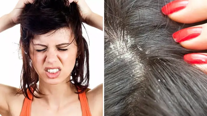 உச்சந்தலை பருக்கள், கட்டிகள், புண்களை போக்கும் ஜாதிக்காய், மஞ்சள், இஞ்சி.