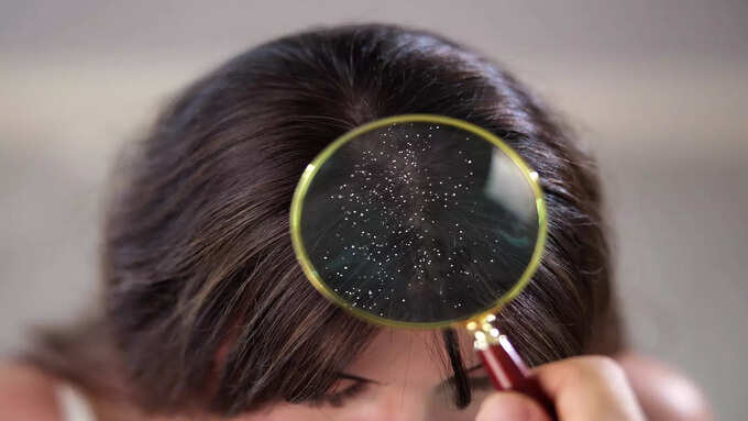 பொடுகு மற்றும் முடி உதிர்தலுக்கு பொடுகு மற்றும் முடி உதிர்தலுக்கு