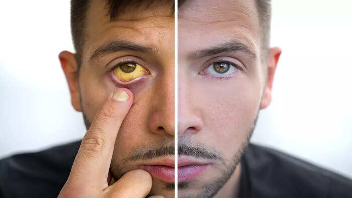 ​ஃபேட்டி லிவர் நோய்க்கு கீழாநெல்லி​