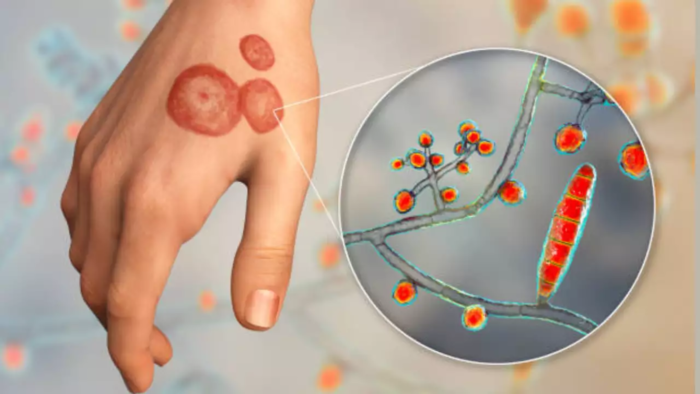 ரிங்வோர்ம் (படர்தாமரை) எதனால் ஏற்படுகிறது? ரிங்வோர்ம் (படர்தாமரை) எதனால் ஏற்படுகிறது?